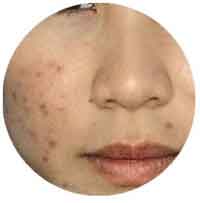 Get rid your acne marks now