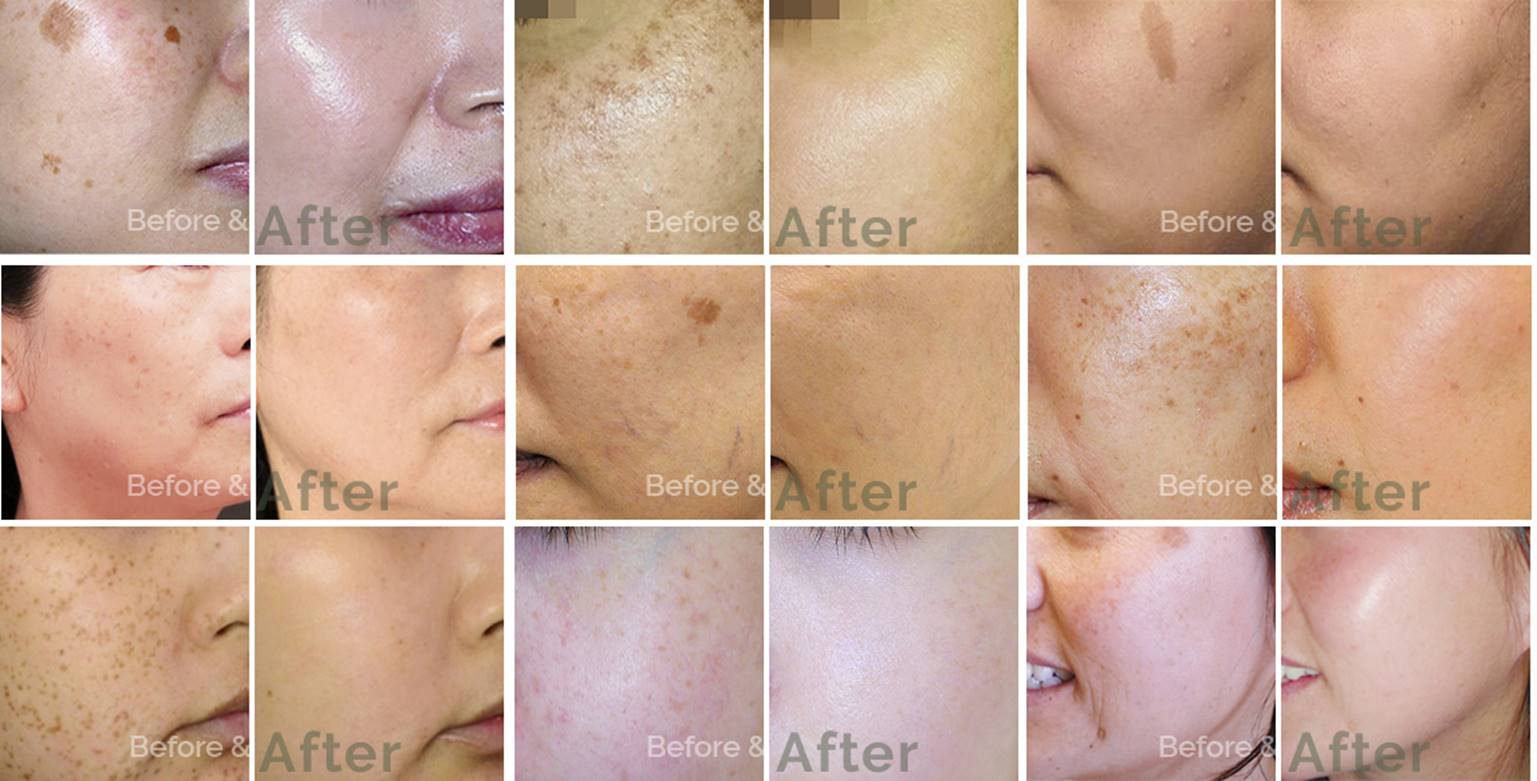 Age Spots Removal Before and After. Safe Procedures with Proven Results.