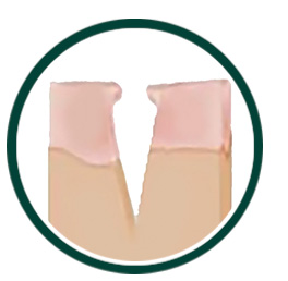 Acne Scar Treatment Process Step 1
