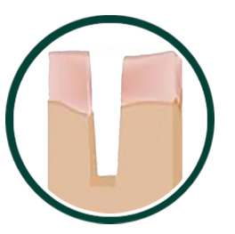 Acne Scar Treatment Process Step 2