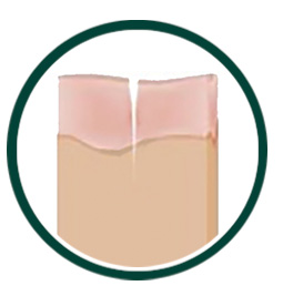 Acne Scar Treatment Process Step 3