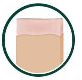 Acne Scar Treatment Process Step 4