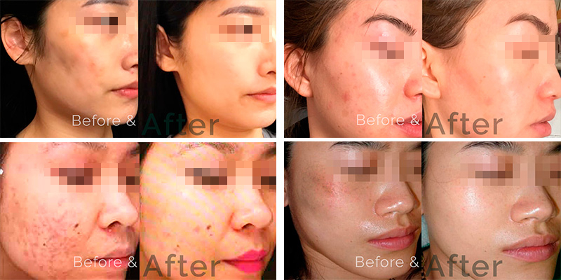 Facial Before and After. Safe Procedures with Proven Results.