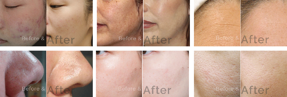 Facial Before and After. Safe Procedures with Proven Results.
