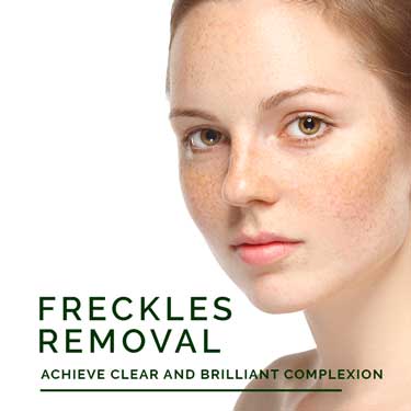 Freckles Removal Treatment