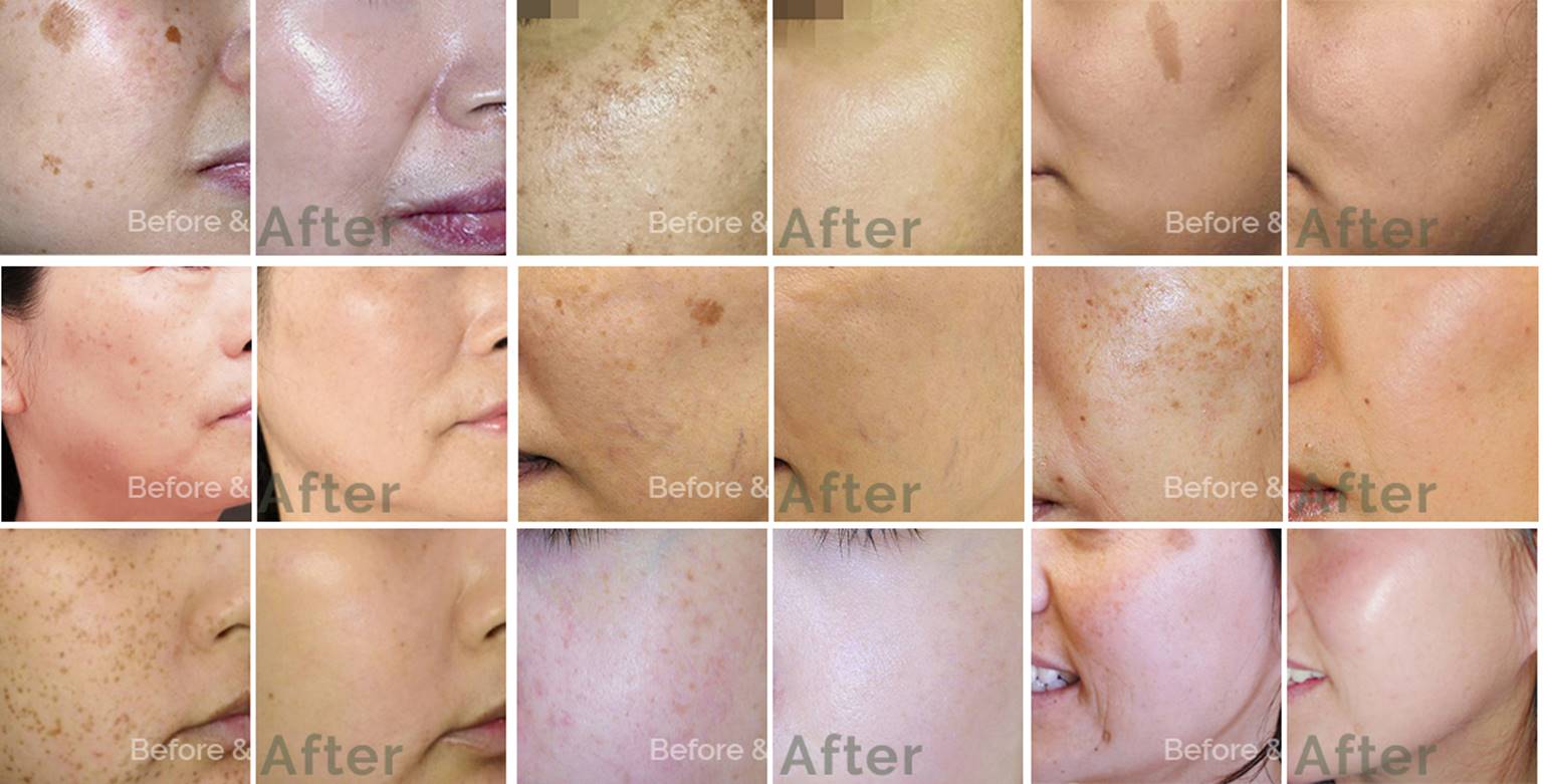 Pigmentation Removal Before and After. Safe Procedures with Proven Results.