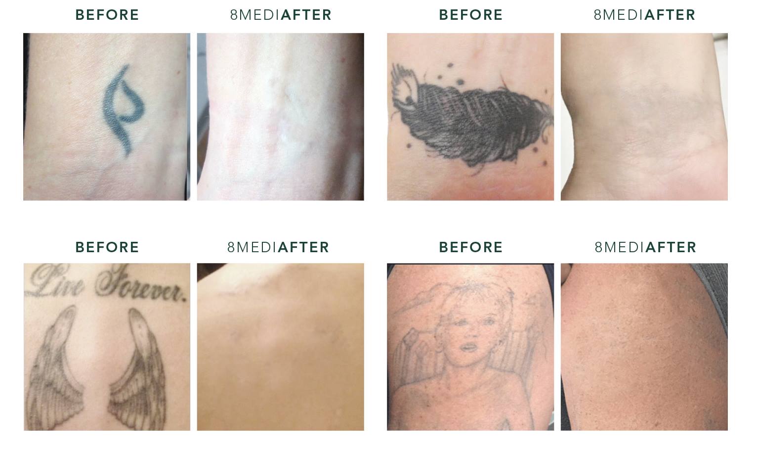 Tattoo Removal Before And After2 